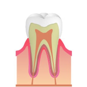 CO…エナメル質表層のみに出来た虫歯