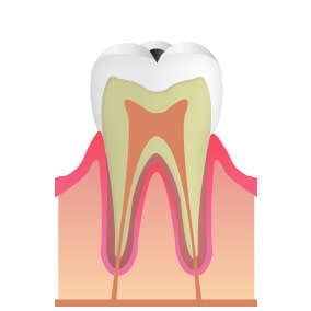 C1…エナメル質内の虫歯
