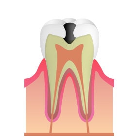 C2…象牙質まで到達した虫歯