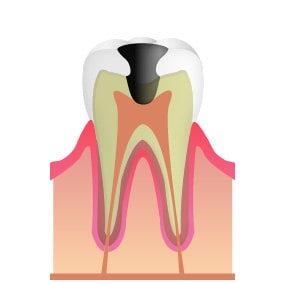 C3…歯髄まで到達した虫歯