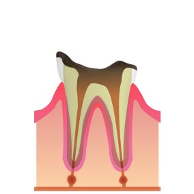 C4…歯冠が崩壊し歯根だけ残った虫歯